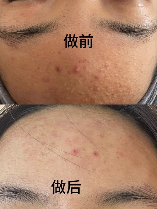 theyeon多妍祛痘真的有效吗？-图1