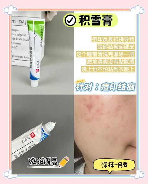 小林制药祛痘膏怎么用才有效？-图1
