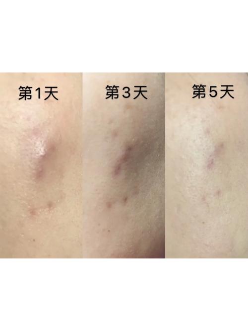 wis祛痘印效果怎么样-图1