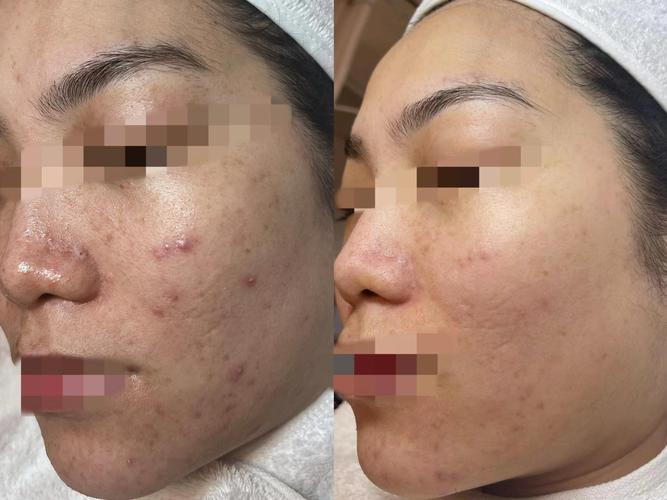 wis祛痘印效果怎么样-图2