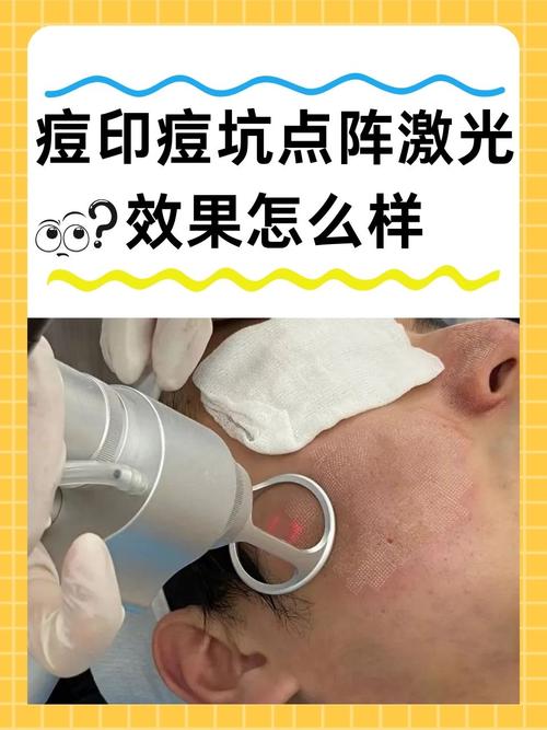 E光祛痘和激光祛痘哪个更好？-图1