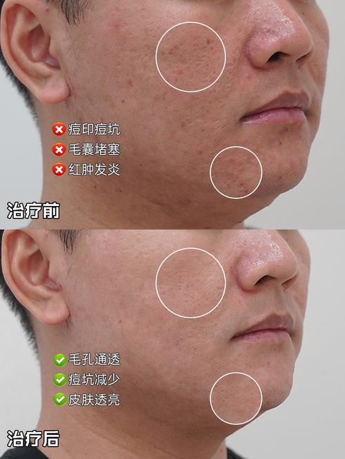 E光祛痘和激光祛痘哪个更好？-图3