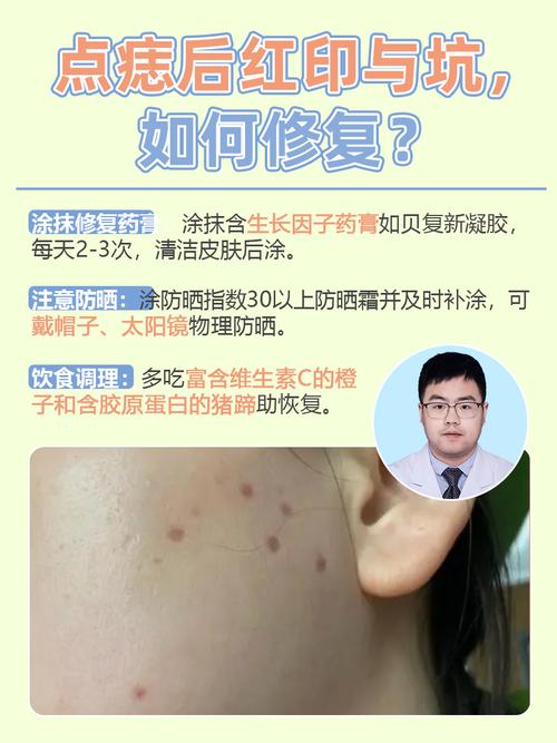 祛痣后多久可以用护肤品-图3