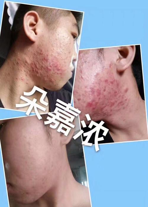 朵嘉浓祛痘到底有没有用？-图1