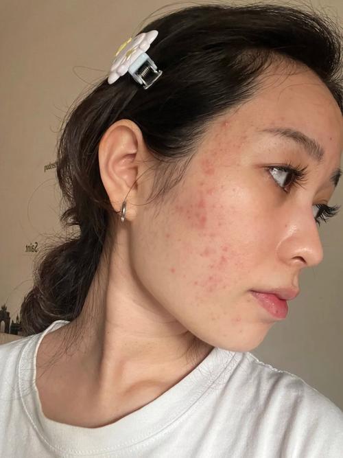 果酸祛痘效果好不好?-图2 果酸祛痘效果好不好?-图2