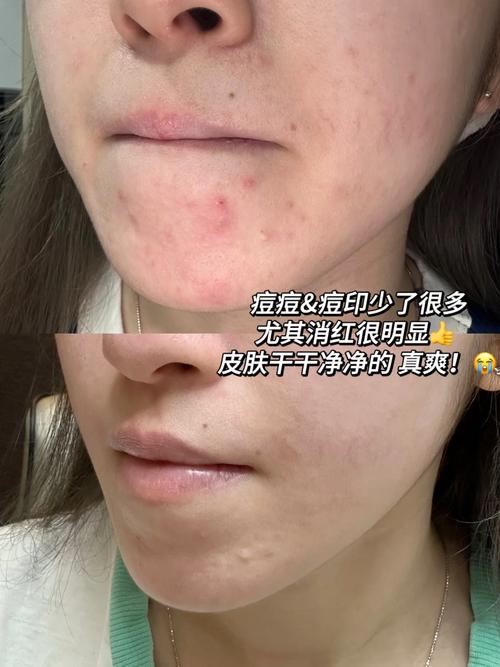 果酸祛痘效果好不好?-图1 果酸祛痘效果好不好?-图1