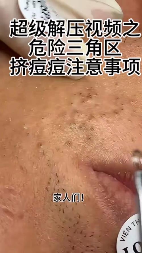 祛痘视频真的能祛痘吗？-图3