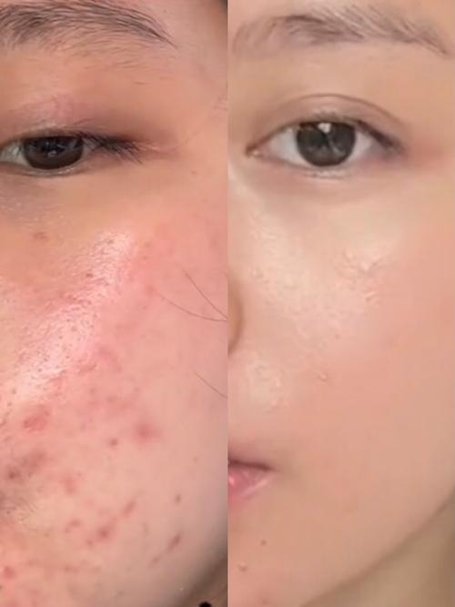 祛痘视频真的能祛痘吗？-图1