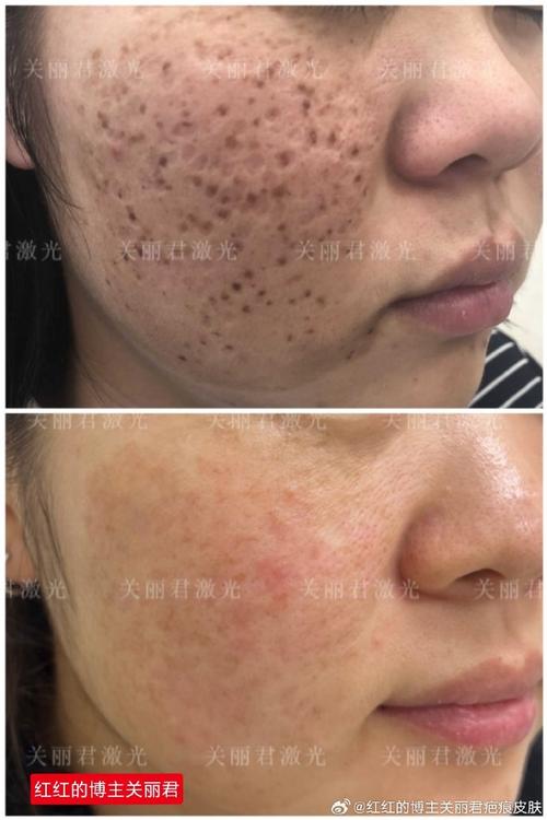 激光祛痘坑后坑变大了-图1 激光祛痘坑后坑变大了-图1