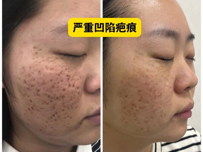 激光祛痘坑后坑变大了-图2