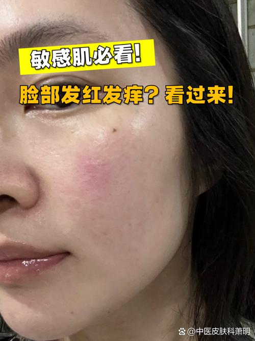 护肤品过敏脸红肿怎么快速缓解?-图1 护肤品过敏脸红肿怎么快速缓解?-图1