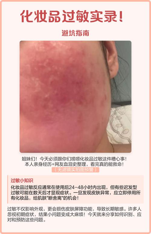 护肤品过敏脸红肿怎么快速缓解?-图3 护肤品过敏脸红肿怎么快速缓解?-图3