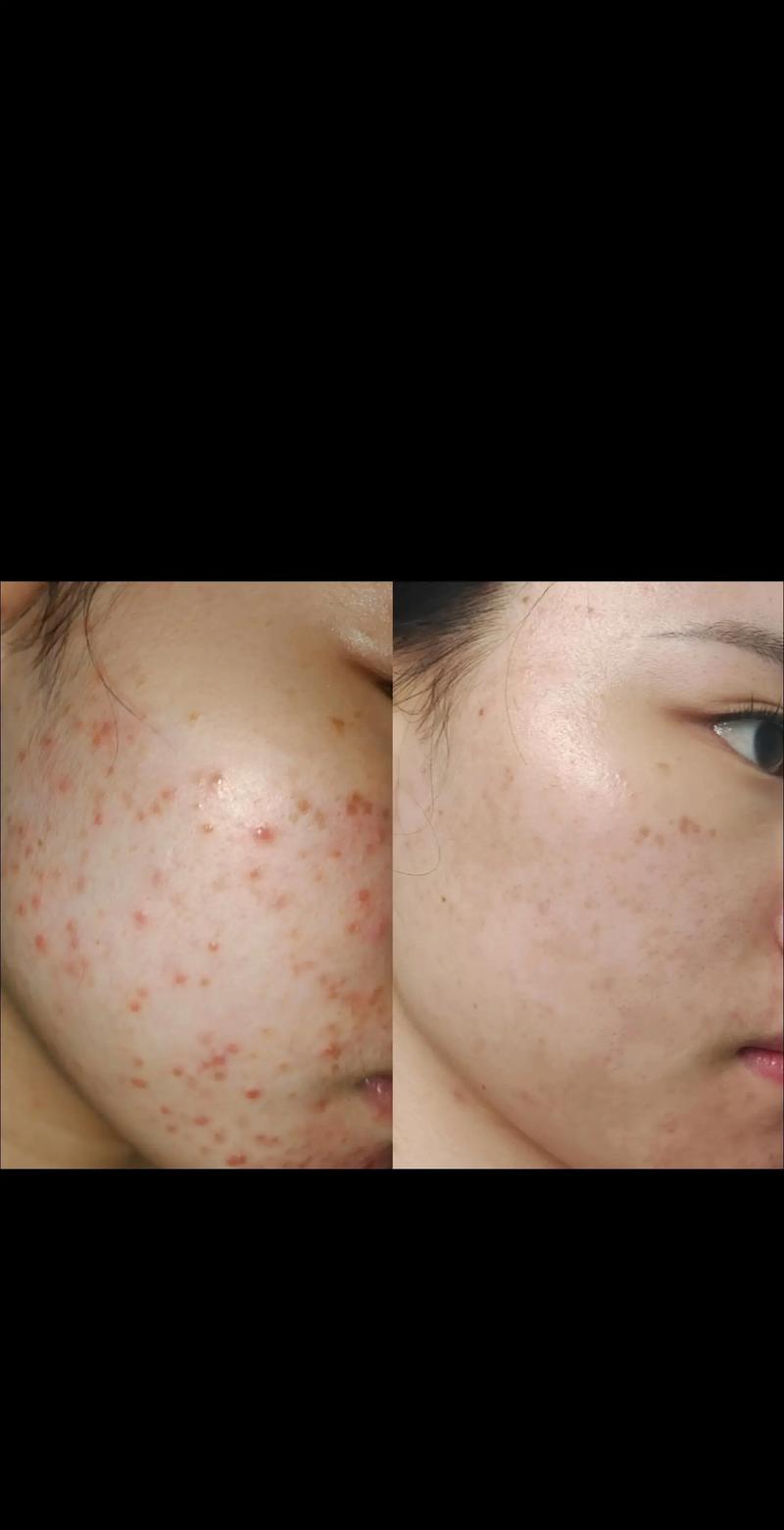 激光祛痘效果到底好不好？-图2