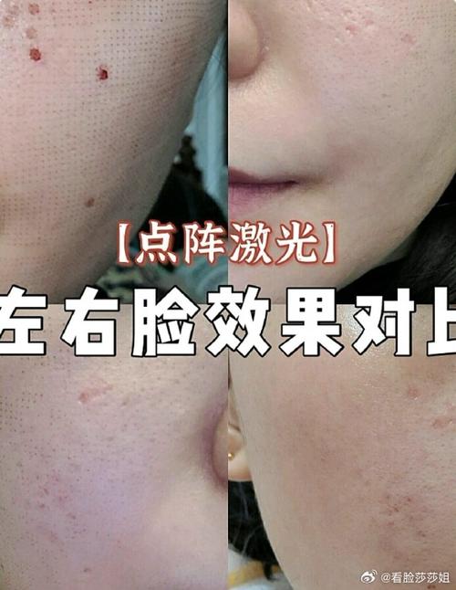 激光祛痘效果到底好不好？-图3