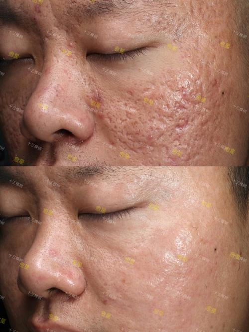 激光祛痘效果到底好不好？-图1