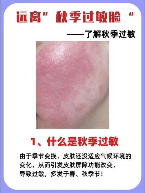 护肤品过敏脸涂了怎么办？-图3