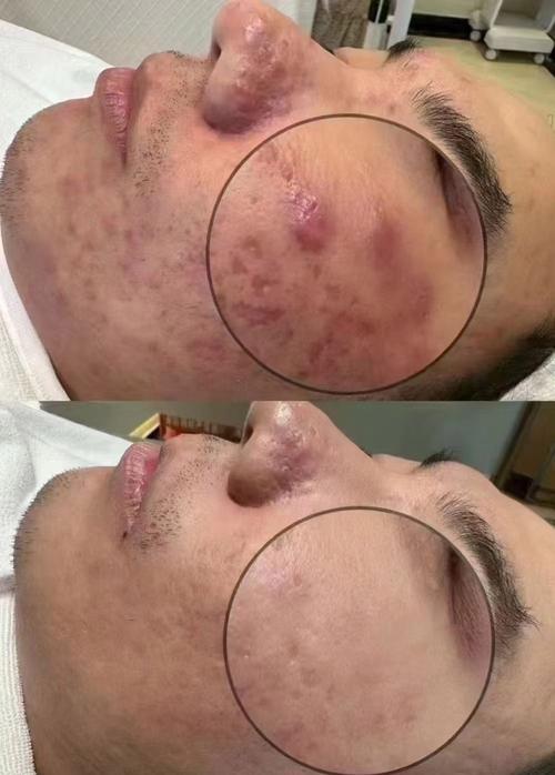 盐水祛痘真有效吗？-图3