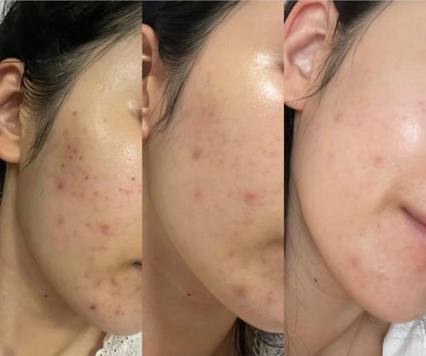 盐水祛痘真有效吗？-图2