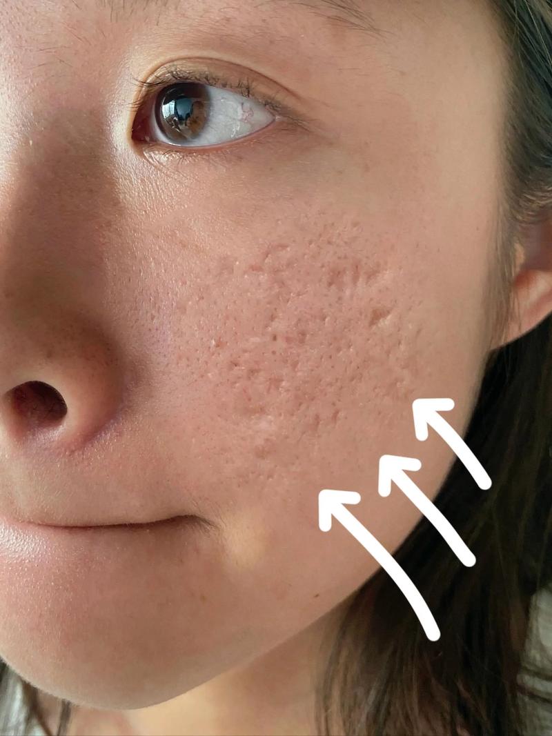 玻尿酸原液真能祛痘坑吗？-图3