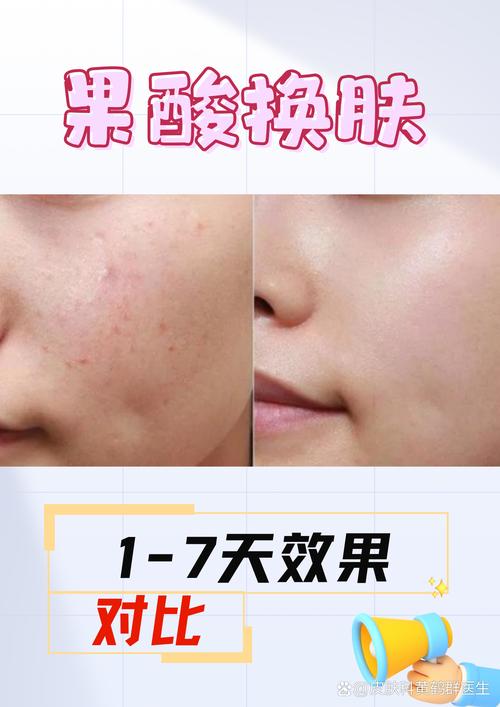 韩方祛痘消印几天见效？-图2