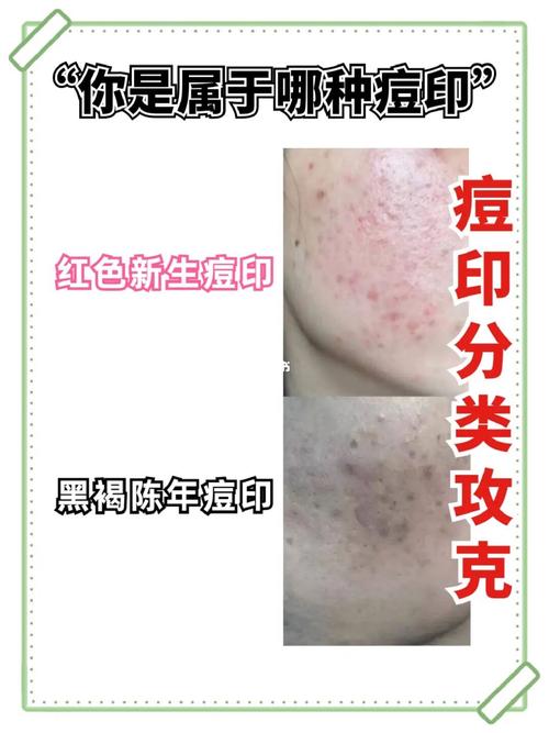如何有效祛除红黑痘印？-图3