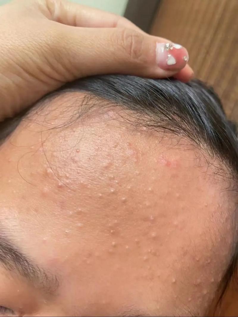 中药敷脸祛痘印到底有没有用？-图3