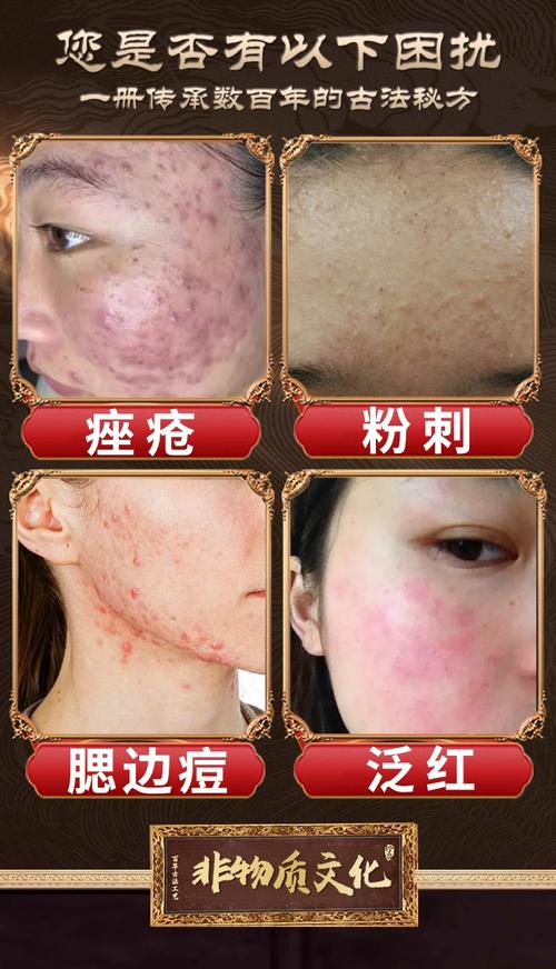 脸上长痤疮到底能不能用护肤品？-图3