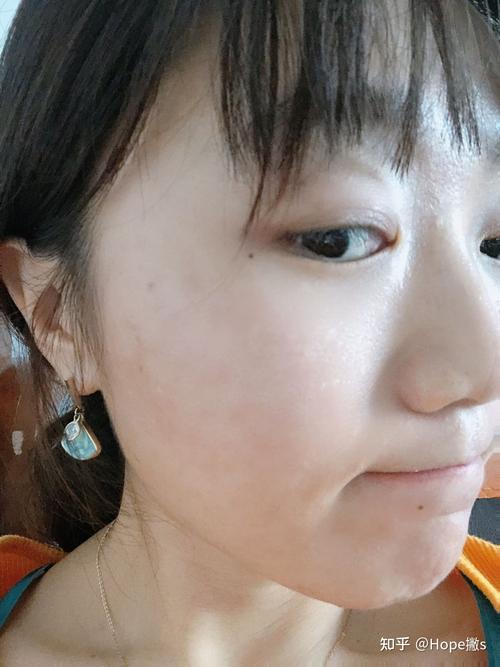 狮王祛痘膏涂完痒是正常反应吗？-图3