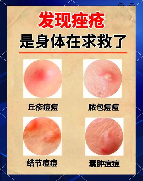 祛痘排毒到底排的是什么毒？-图2