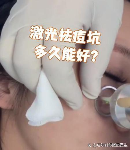 激光祛痘多久见效？-图2