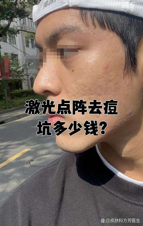 激光祛痘多久见效？-图3