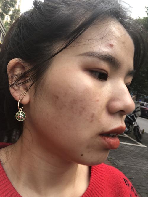 绿色的祛痘膏为何能祛痘？-图3