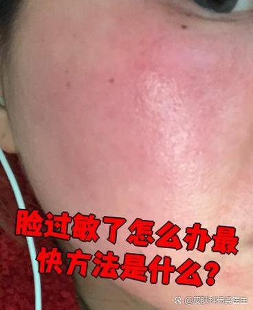 脸上过敏，护肤品还能用吗？-图3