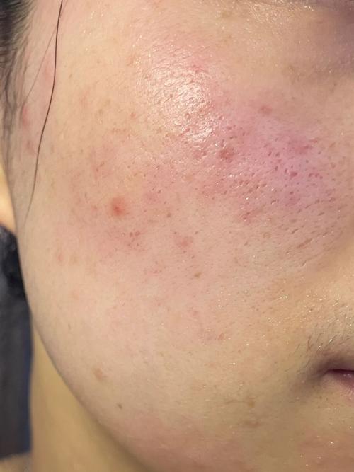 肌美精祛痘面膜过敏怎么办?-图2 肌美精祛痘面膜过敏怎么办?-图2