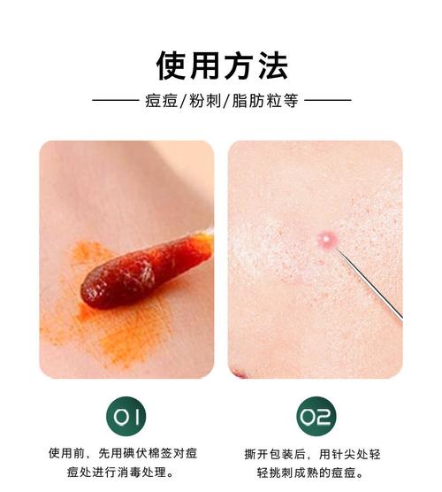 祛痘针挑破痘痘安全吗？-图3