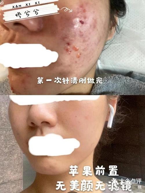 祛痘针挑破痘痘安全吗？-图1