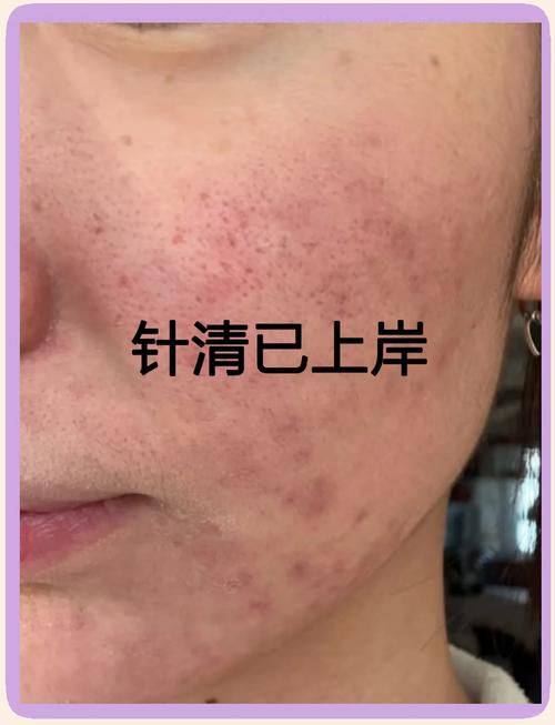 祛痘针挑破痘痘安全吗？-图2