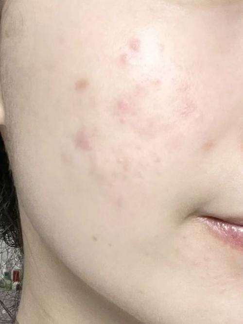 祛痘补水面膜，到底哪款真正好用？-图1