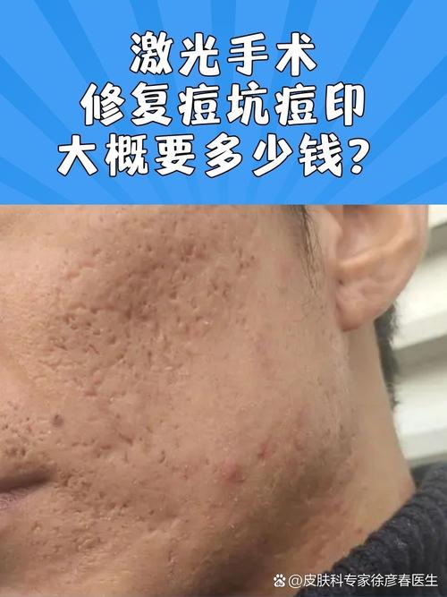 激光祛痘一般要多久见效？-图3