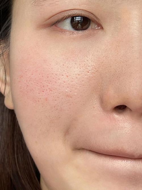 天然祛痘美白缩小毛孔,真能同时实现吗?-图1 天然祛痘美白缩小毛孔,真能同时实现吗?-图1