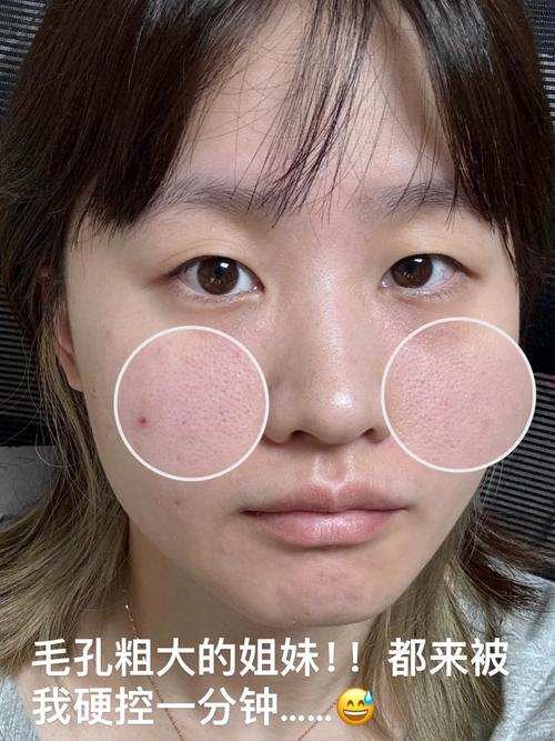 天然祛痘美白缩小毛孔,真能同时实现吗?-图3 天然祛痘美白缩小毛孔,真能同时实现吗?-图3