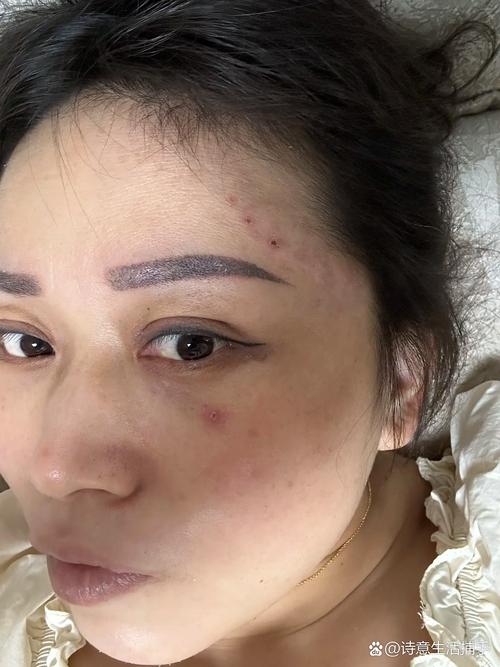 祛痘后为何不能化妆？-图2