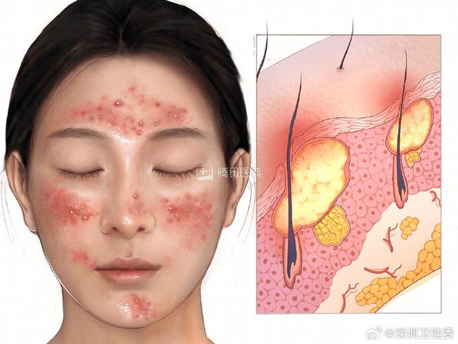 祛痘后为何不能化妆?-图1 祛痘后为何不能化妆?-图1