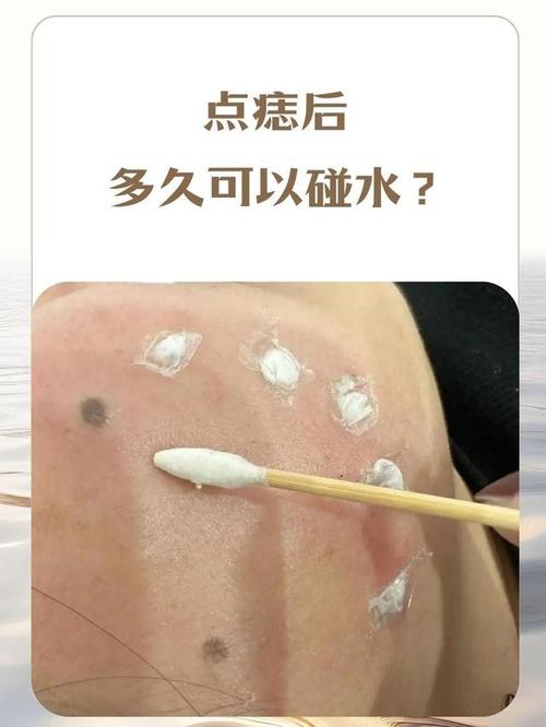 点痣后多久能用护肤品？-图2