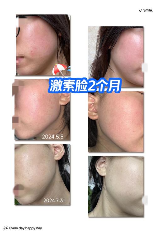 祛痘精华含激素吗？-图3