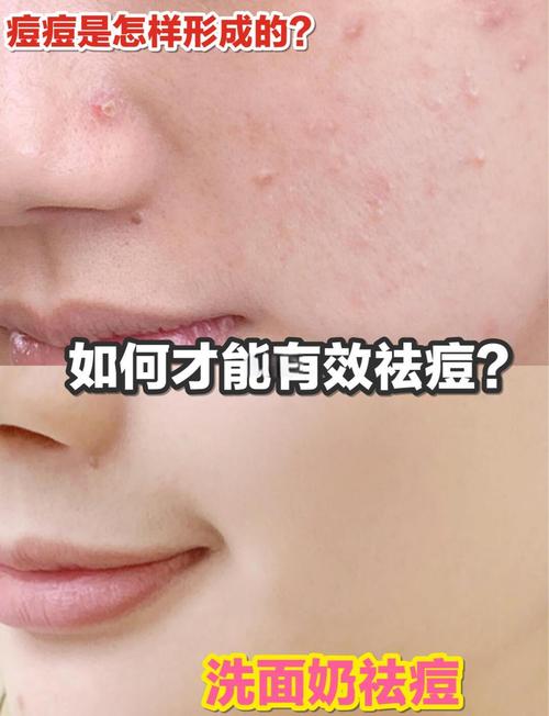 男士祛痘印最快方法是什么？-图1