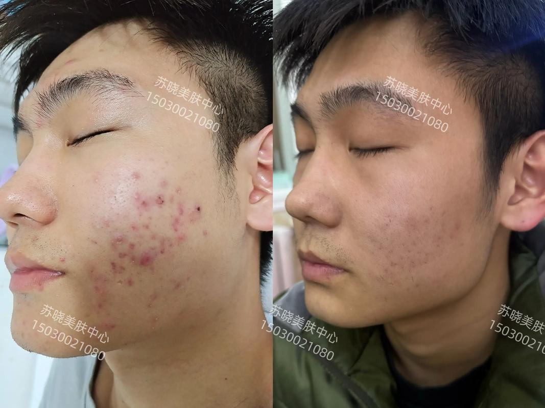 男士祛痘印最快方法是什么？-图2