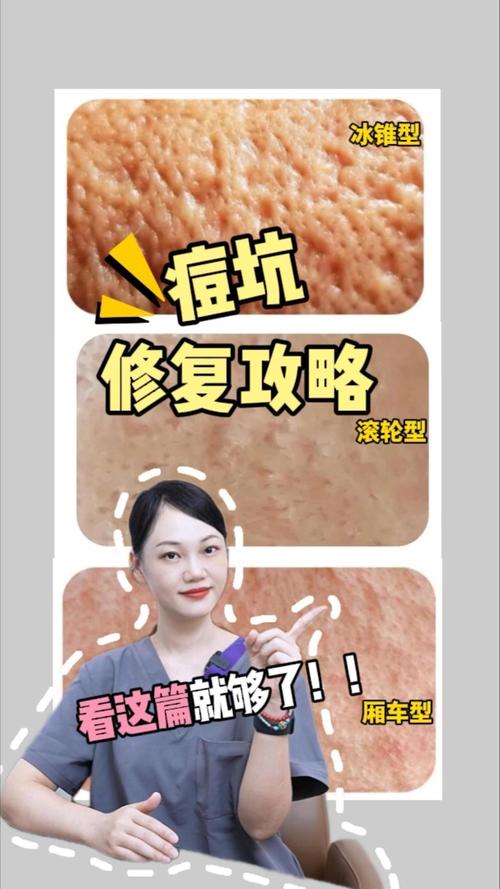 玻尿酸祛痘坑真的有效吗？-图3