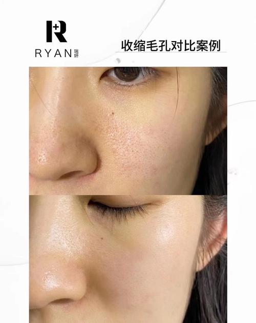 祛痘印收缩毛孔，选哪个产品更好？-图1