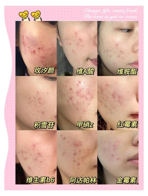 红痘印修复品选哪种好？-图3